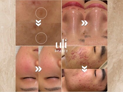 ウリ(uli beauty)の写真