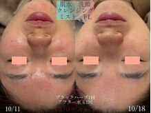 サロンヴェアリー 広尾(salon vary)/水玉+ハーブピーリング