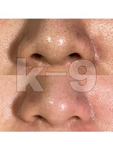 ケイナイン(K-9)/鼻脱毛で毛穴レス
