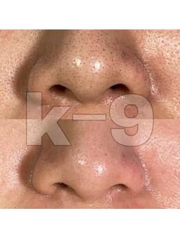 ケイナイン(K-9)/鼻脱毛で毛穴レス