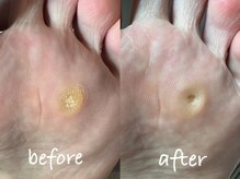 ポドウオーク(PODO WALK)/タコ・魚の目ケア