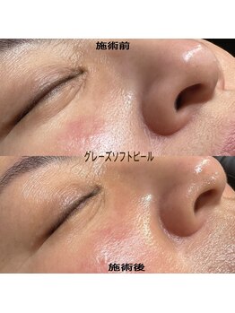 ブライズ(BRISE)/グレーズソフトピール