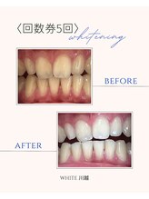 ホワイト 川越店(WHITE)/歯のBefore→After