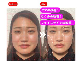 栄光治院 安城院/美容鍼　【ビフォー/アフター】