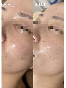 ビューティーサロン プティ(beauty salon petite)/ハーブピーリング×幹細胞導入