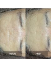 ヒール(heal)/50代　おでこのシワ改善！