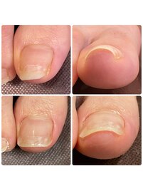 トラブルフットケア