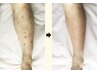 【施術部位小】小さな掻き傷に/傷跡ケア/グリーンピールボディ1day  ¥42900→