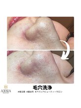 アクシア ビューティー サロン(AXSIA)/【毛穴洗浄】BeforeAfter 