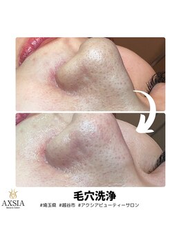 アクシア ビューティー サロン(AXSIA)/【毛穴洗浄】BeforeAfter 