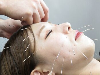 かねこ鍼灸接骨院/当院1番人気☆美容鍼！