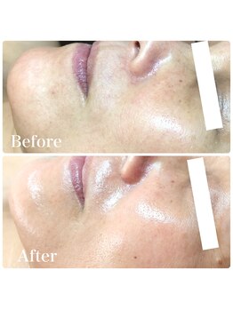 ポードジェーン(peau de jeune)/REVIハーブピーリング