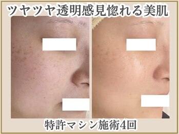 ポモナ 横浜馬車道店(Pomona)の写真/[シミ肌改善×美肌づくり]潜んでいるシミにも目立つシミにもアプローチ!40代50代の品格ある魅力を最大限に