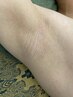 【平日10：00～15：00限定】ワキ脱毛 1回￥1300！！
