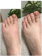 アミィ(amii)/筋膜リリース