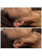 ハル(Halu)/二重顎/たるみ改善！