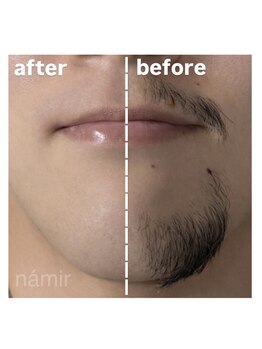 脱毛サロンnamir札幌店【ブラジリアンワックス/美容脱毛/眉毛】～メンズ/レディース～/men's【ひげ脱毛】