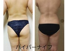 ウーム/ハイパーナイフ uuum