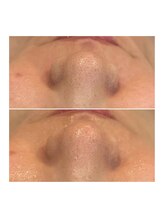 ベル(Bell)/フォト美顔1回の施術効果