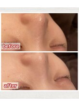 スパ クアリタ(spa qualita)/光フェイシャルで毛穴引き締め！