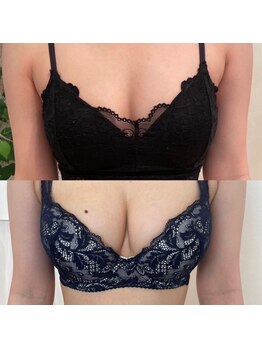 メゾン アンジュ(Maison Ange)/バストアップ症例B→E/育乳