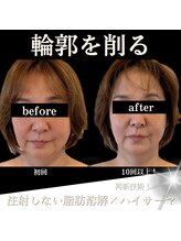 クリニカルボーテ 心斎橋院(CLINICAL BEAUTE)/絶対言われる「痩せた！？」
