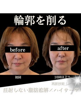 クリニカルボーテ 心斎橋院(CLINICAL BEAUTE)/絶対言われる「痩せた！？」