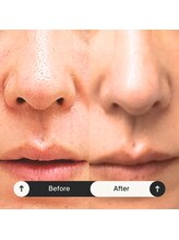 ゆう/毛穴に注目！