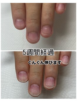 ココ ネイル サロン アンドスクール(COCO.NAIL SALON&SCHOOL)/爪噛み改善メニュー