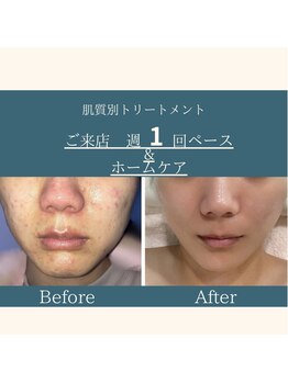 エステ大阪PON/ニキビの鎮静/荒れない肌作り