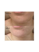 リコア(Likoa)/2回目のbefore afterです