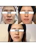 ♪シミ・シワ・ニキビ改善♪E-LIGHTフェイシャルコース10分