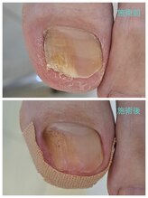 レフス 北参道店(REFUSS)/長年抱えていた爪のトラブル