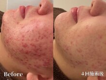 リソルバイスリール(Re:sol by sourire)の雰囲気(3種類のハーブピーリングから最適なハーブピーリングをご提案◆)