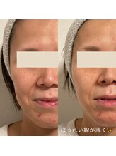 ひっそり美肌構築/ほうれい線薄く♪