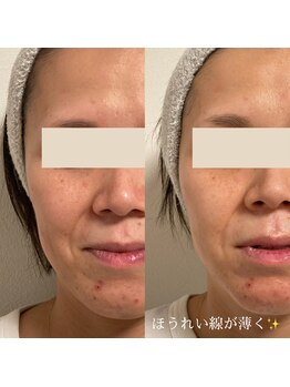 ひっそり美肌構築/ほうれい線薄く♪