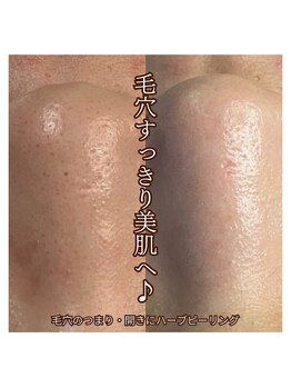 ハリサロンドオフ 西梅田店(hari salon de off)/毛穴ケアビフォーアフター
