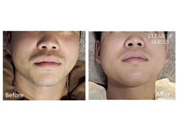 アットイカウ 下北沢(at ikaw)/全顔スッキリ脱毛 Before/After