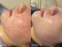 リリアス(RILLIAS)/赤み、ニキビケア