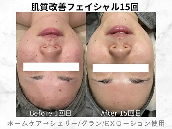 リライン(ReLine)/【リアボーテフェイシャル15回】