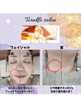 ティンクル サロン(Twinkle salon)/BBL光トリートメント