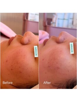 ミラー(MIRAOR)/同じ箇所に繰り返すニキビケア☆