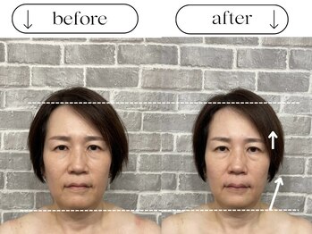 ビースタイル(B-style)/【電気美容鍼】ビフォーアフター