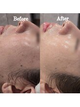 イチグラム(Ichi Glam)/ハーブピーリング効果