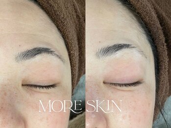 モアスキン 南青山店(MORE SKIN)/頑固なおでこのシワに