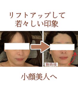 メディカモン(medikamon)/引き上がった輪郭へ