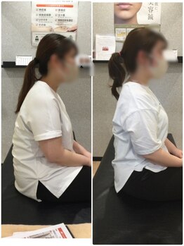 くすの樹接骨院 整体院 吉野ヶ里院/整体/骨盤矯正ビフォーアフター