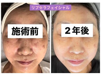 プリュネル(Prunelle)/プラズマシャワー