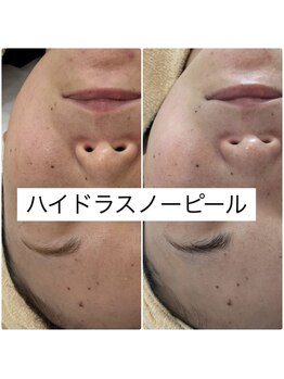 レピア(Le'pia)/ハイドラスノーピール