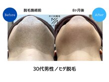 メンズアメリ/高知/メンズ脱毛/ヒゲ/全身/VIO